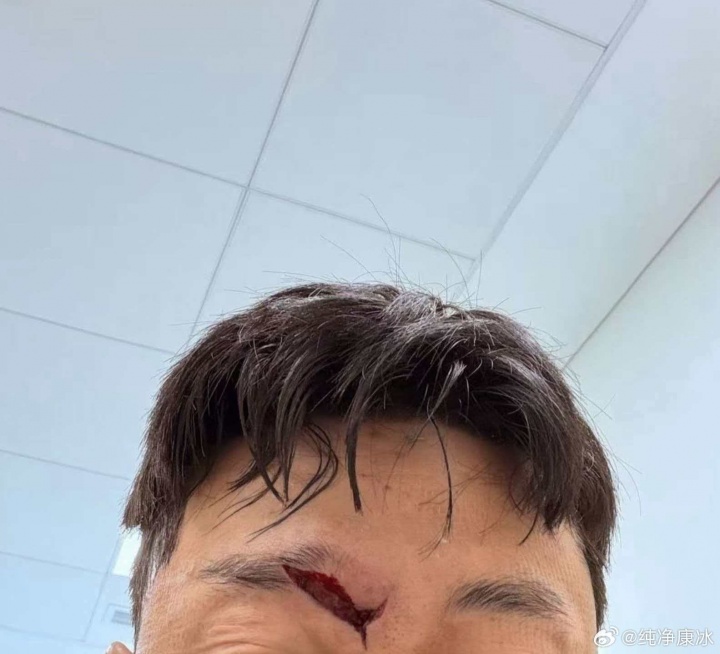 华体会-山东解说：高准翼轻微脑震荡缝了30多针，现在应该问题不大了